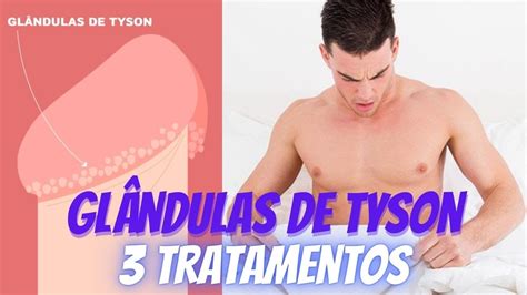 Glândulas de Tyson (prepuciais): o que são e como é。